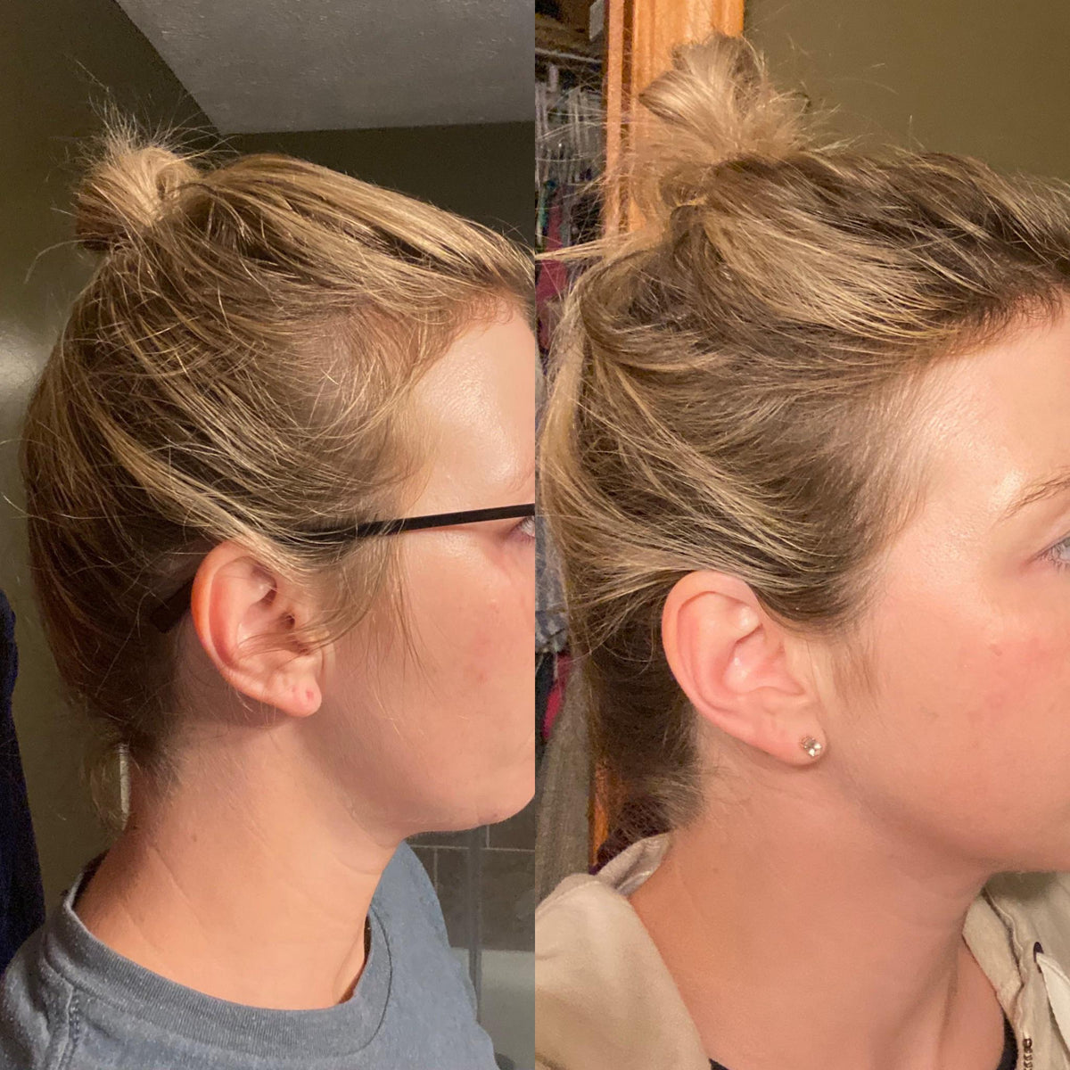 Beautyline Lissia Tónico capilar control caida minoxidil 2%